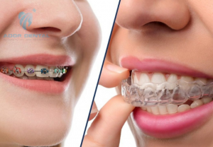 niềng răng mất bao lâu