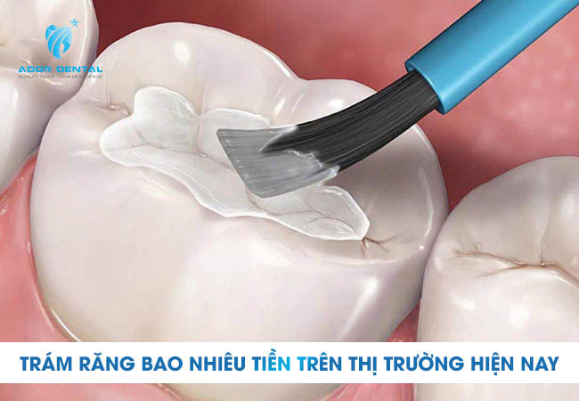 Trám răng tại Tây Ninh bao nhiêu tiền