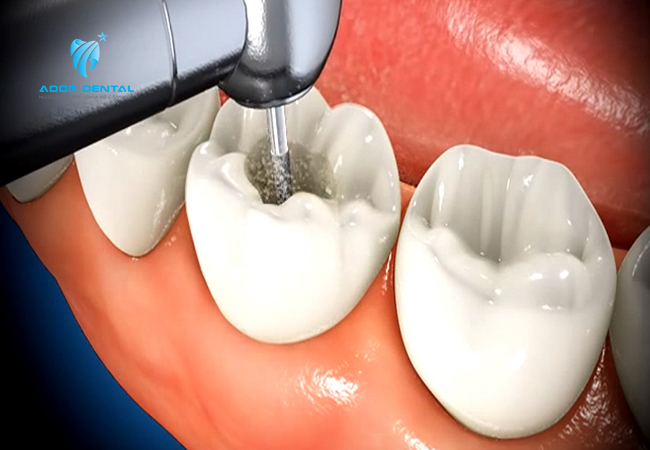 Chữa tủy răng sau khoảng 1-2 tuần thì sẽ giảm đau và dần biến mất sau đó