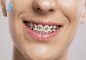 Lợi Ích Của Niềng Răng Là Gì? Niềng Răng Có Tác Hại Gì Không?