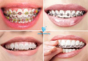 Các Loại Niềng Răng Hiện Nay - Loại Nào Thích Hợp Nhất Với Bạn?
