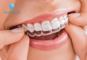 Niềng Răng Trong Suốt Là Phương Pháp Hiện Đại Nhất Hiện Nay Vì Sao?