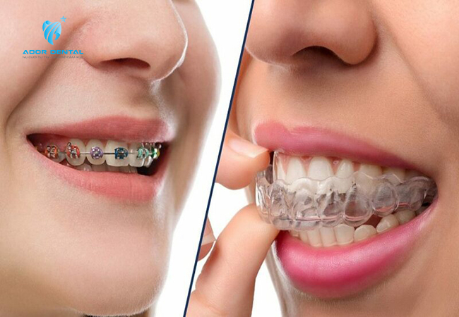 Niềng răng trong suốt có rất nhiều ưu điểm nổi bật