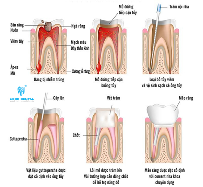 Quy trình chữa tủy răng tại nha khoa Ador Dental