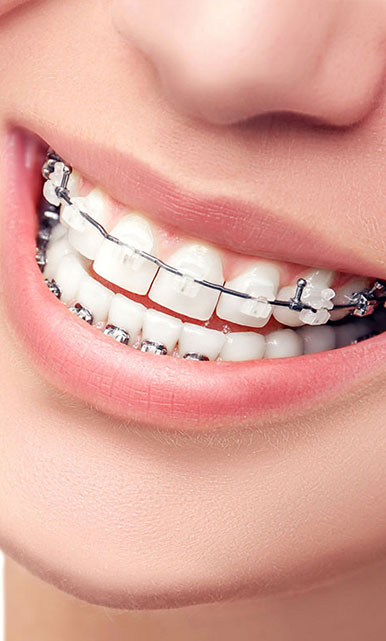 Niềng răng thẩm mỹ
