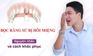 Bọc răng sứ bị hôi miệng