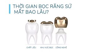 Thời gian để bọc răng sứ mất bao lâu?