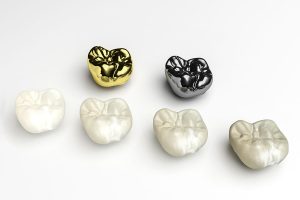 Các loại răng sứ