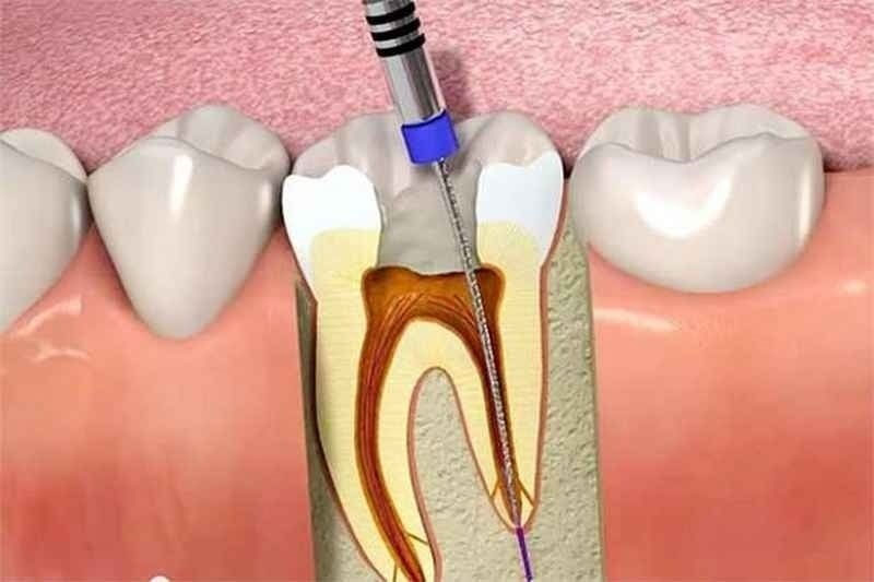 Lấy tủy răng