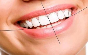 Bọc răng sứ hàm trên