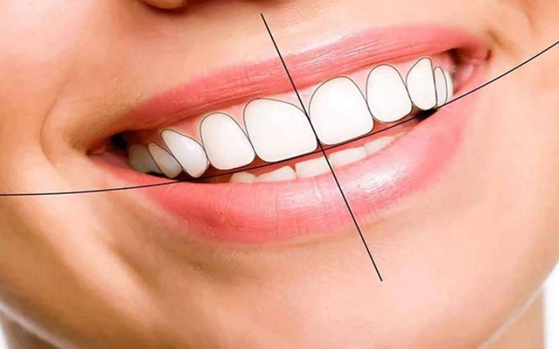 Bọc răng sứ hàm trên