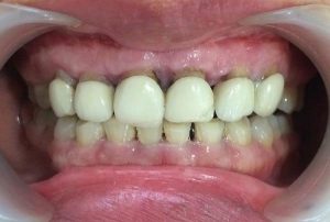 Hậu quả bọc răng sứ kém chất lượng