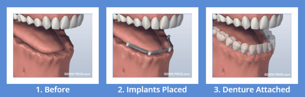 Sử dụng 4 cây  implant cho hàm dưới
