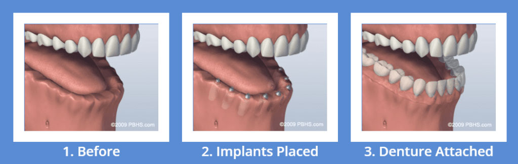 Sử dụng 6 cây  implant cho hàm dưới