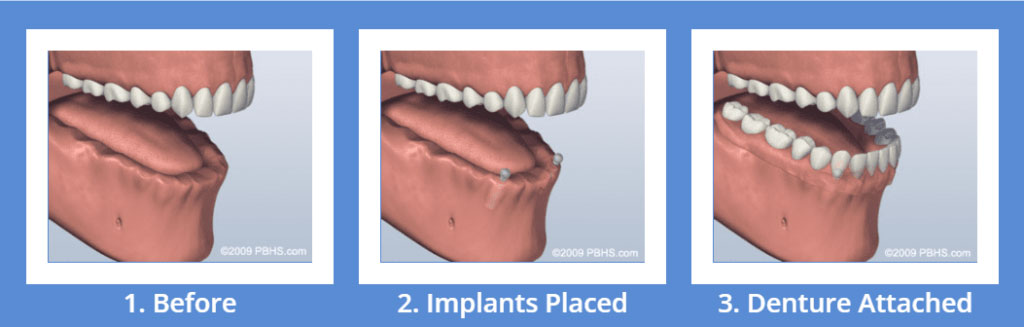 Sử dụng 2 cây  implant cho hàm dưới
